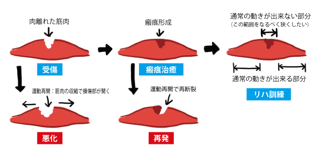 洛西口・桂川で肉離れでお悩み方は、京都中丸整体カイロプラクティックへ