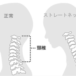 ストレートネックを改善｜京都市西京区【洛西口・桂川】中丸整体カイロプラクティック