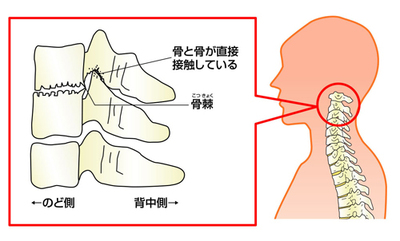 変形性頸椎症の特徴　画像