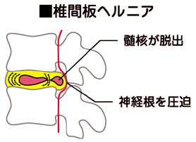 ヘルニアの画像