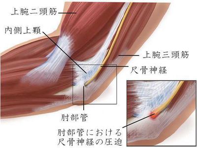 肘部管　画像