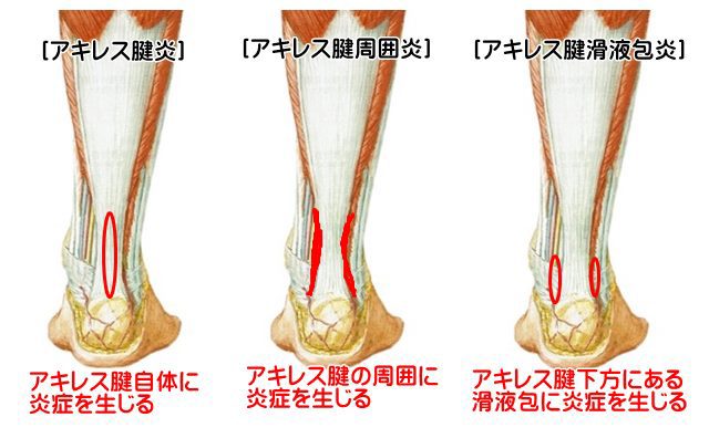 京都市西京区でスポーツ障害でお悩みの方は京都中丸整体カイロプラクティックへ