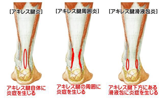 京都市西京区でスポーツ障害でお悩みの方は京都中丸整体カイロプラクティックへ