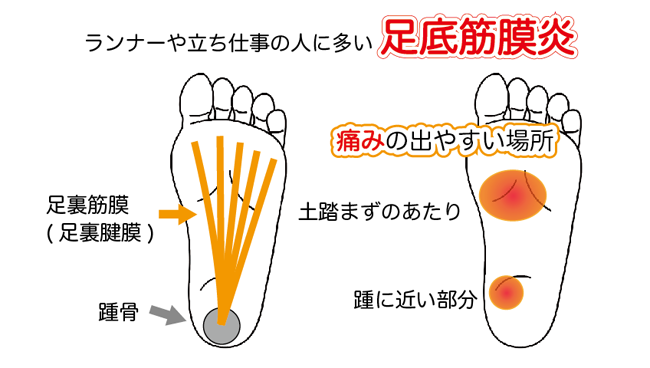 足の裏の痛みで京都市西京区の整体をお探しの方は、京都中丸整体カイロプラクティックへ