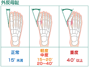 外反母趾のことなら、京都市西京区の整体院【京都中丸整体カイロプラクティックへ】