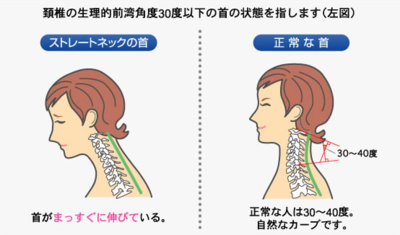 ストレートネック　画像