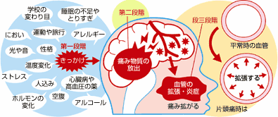 頭痛のメカニズム　画像