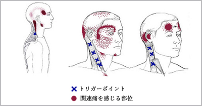 トリガーポイントと関連痛をだす部位　画像