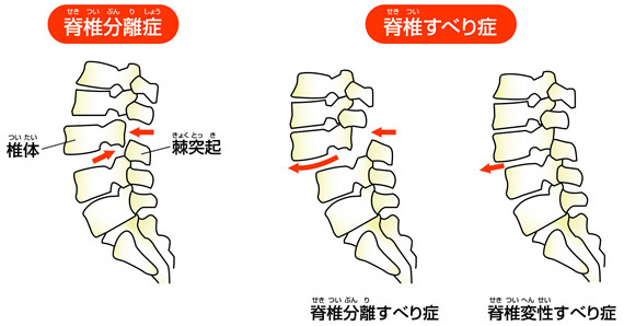 分離症・すべり症の図