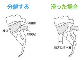 分離とすべりの説明画像