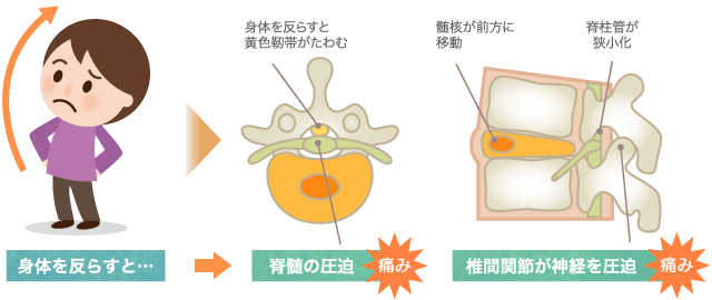 椎間関節症の画像