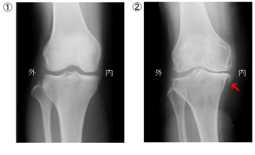 膝の変形画像